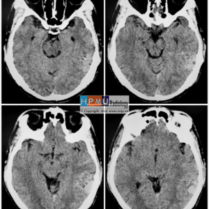 Thông động tĩnh mạch não