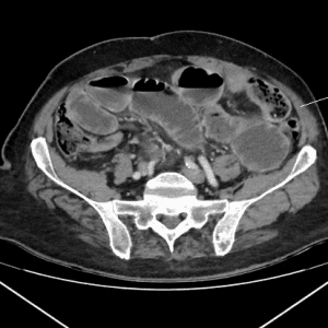 Thủng tạng rỗng