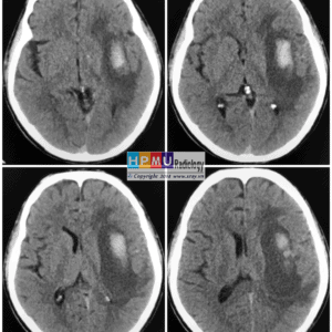 Thông động tĩnh mạch não