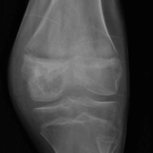 U nguyên bào sụn