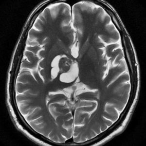 Pilocytic Astrocytoma