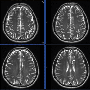 Rộng khoang quanh mạch