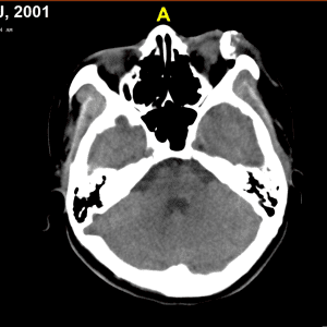 Chấn thương nhãn cầu