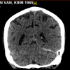 Tụ máu DMC - Hình ảnh 5