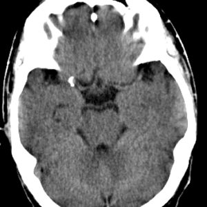 Phình động mạch não