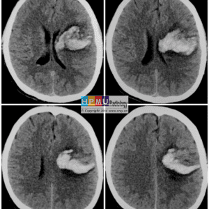 Thông động tĩnh mạch não