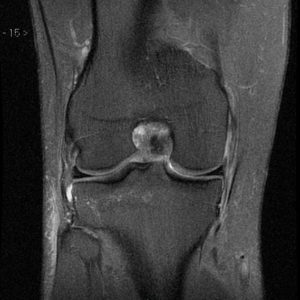 Rách dây chằng bên