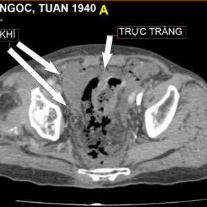 Thủng tạng rỗng