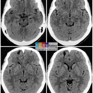 Thông động tĩnh mạch não