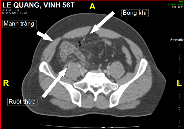 Viêm ruột thừa