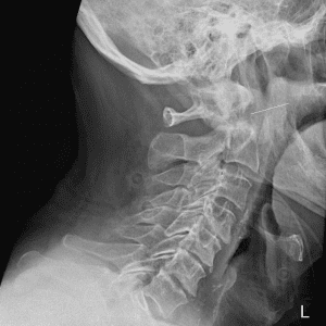 Chấn thương cột sống