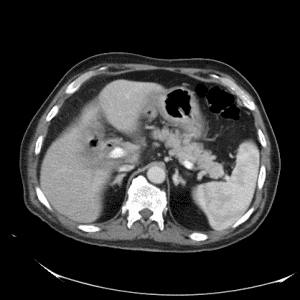 Tắc ruột sỏi mật