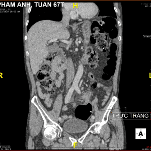 Xoắn đại tràng