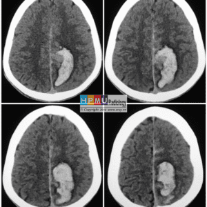 Thông động tĩnh mạch não