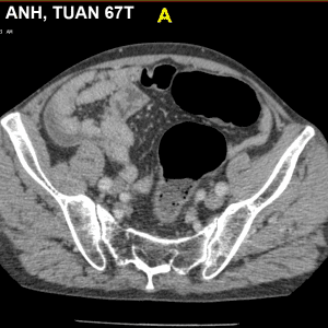 Xoắn đại tràng