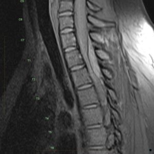 Tụ máu ngoài màng cứng