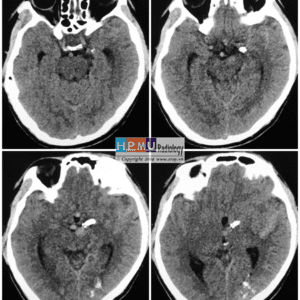 Thông động tĩnh mạch não