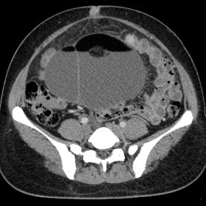 U quái buồng trứng