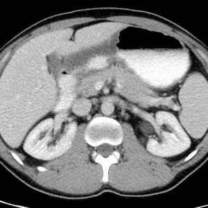 Viêm loét dạ dày