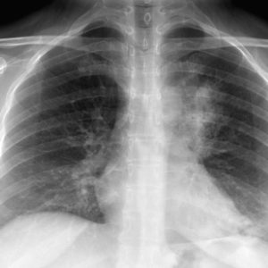 K biểu mô tuyến