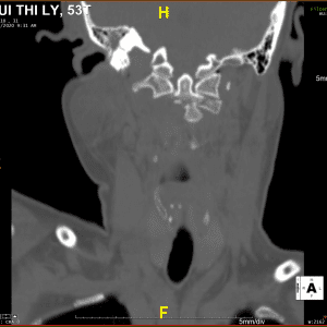 Chấn thương cột sống