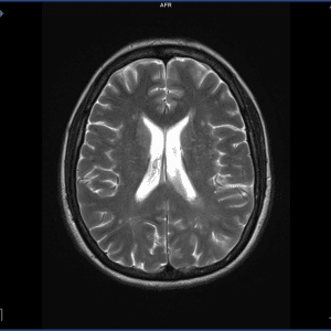 Tụ máu não thất