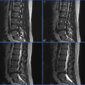 Thoát vị đĩa đệm
