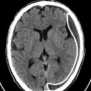 Tụ máu dưới màng cứng