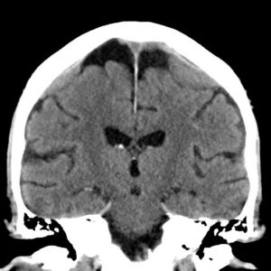 Di căn màng cứng / K tiền liệt tuyến