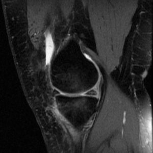 Rách sừng sau sụn chêm trong