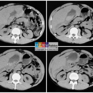 Chấn thương túi mật