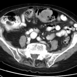 Lồng đại tràng ngang