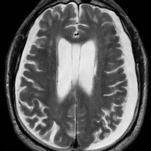 Tụ dịch dưới màng cứng