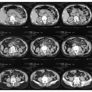 Thâm nhiễm rễ mạc treo