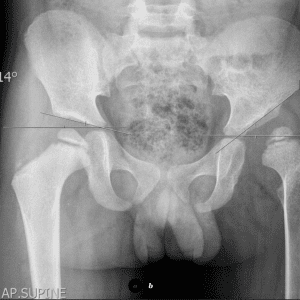 Loạn sản khớp háng trái tiến triển