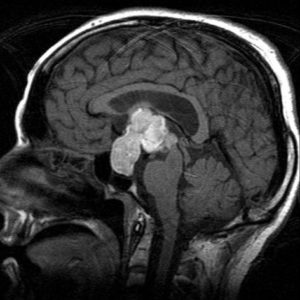 Chảy máu tuyến yên