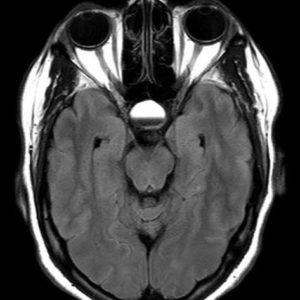 Chảy máu tuyến yên
