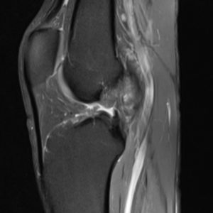 Đứt dây chằng chéo trước