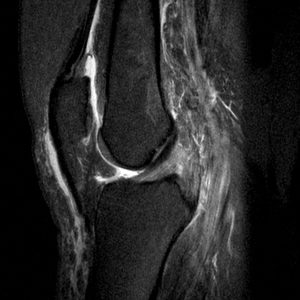 Rách dây chằng chéo sau