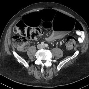 Xoắn đại tràng Sigma