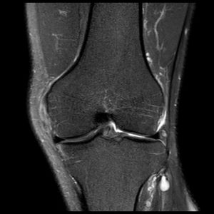 Chấn thương dây chằng