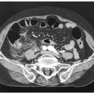 Viêm ruột thừa thủng