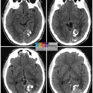 Thông động tĩnh mạch não