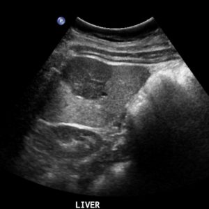 Tăng sản nốt khu trú