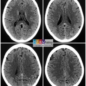 Thông động tĩnh mạch não