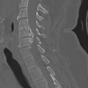 Vôi hóa dây chằng dọc sau