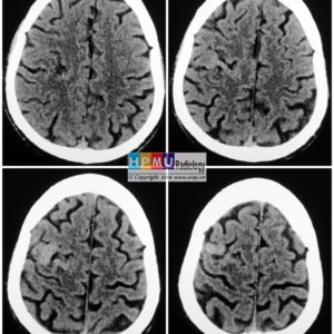 Thông động tĩnh mạch não