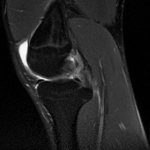 Rách dây chằng chéo sau