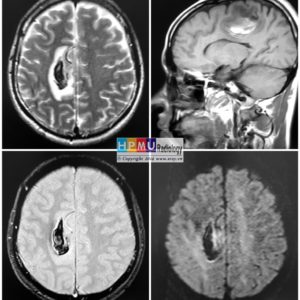 Thông động tĩnh mạch não