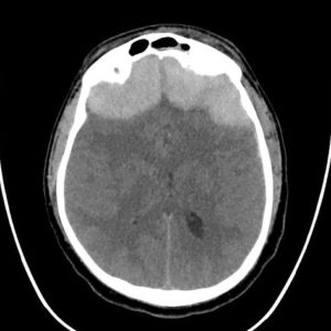 Tụ máu ngoài màng cứng